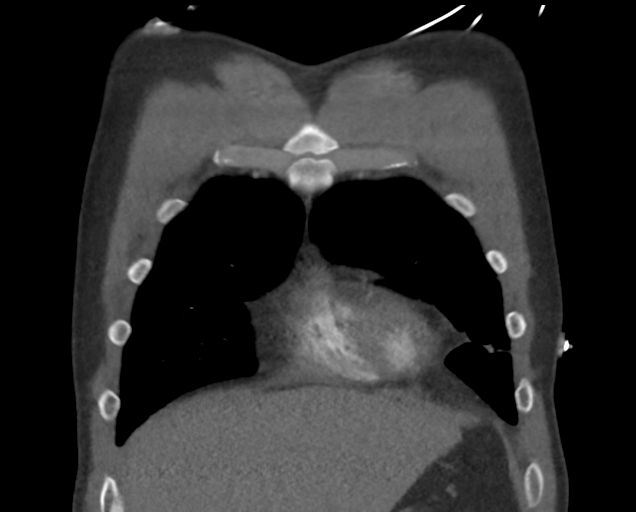 File:Boerhaave syndrome (Radiopaedia 39382-41660 C 20).png