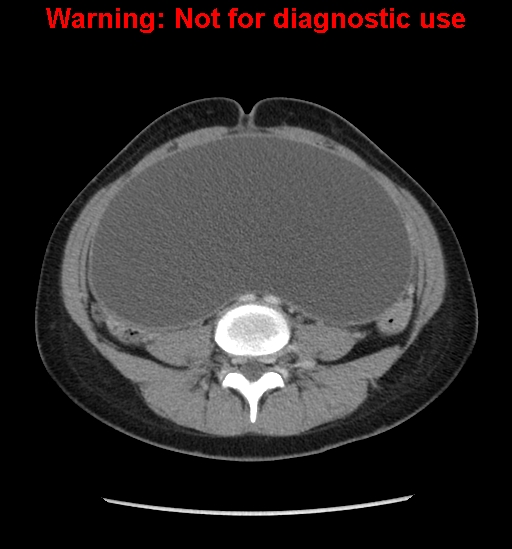 Borderline mucinous cystadenoma of ovary (Radiopaedia 25586-25767 A 50).jpg