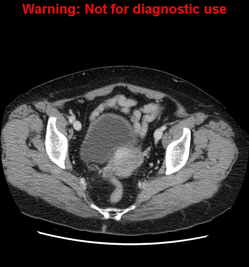 File:Bosniak renal cyst - type II (Radiopaedia 23404-23468 D 64).jpg
