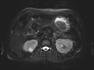 File:Bouveret syndrome (Radiopaedia 61017-68856 Axial MRCP 24).jpg