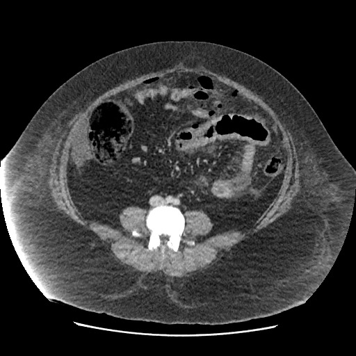Bowel and splenic infarcts in acute lymphocytic leukemia (Radiopaedia 61055-68915 A 83).jpg