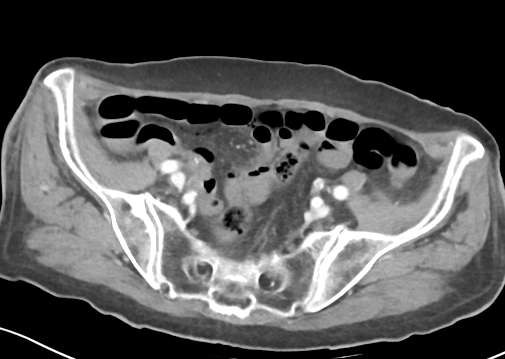 File:Bowel ischemia (Radiopaedia 58273-65382 A 48).png