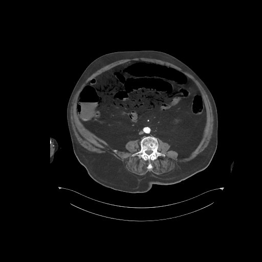File:Bowel ischemia secondary to SMA occlusion with extensive portomesenteric venous gas (Radiopaedia 54656-60871 A 29).jpg