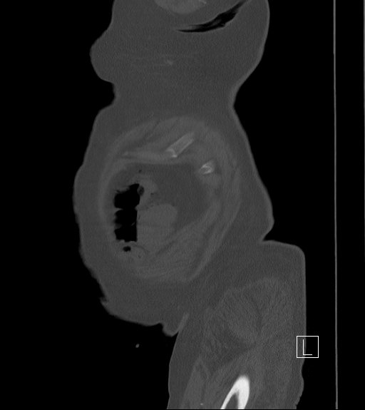Bowel ischemia secondary to SMA occlusion with extensive portomesenteric venous gas (Radiopaedia 54656-60871 Sagittal bone window 110).jpg