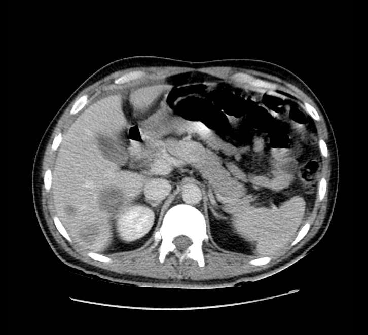 Bowel obstruction from colon carcinoma (Radiopaedia 22995-23028 A 21).jpg