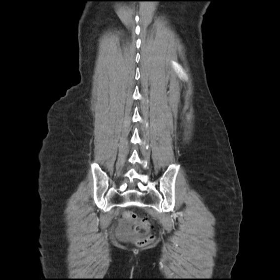 Bowel perforation at ERCP (Radiopaedia 59094-66394 A 50).jpg