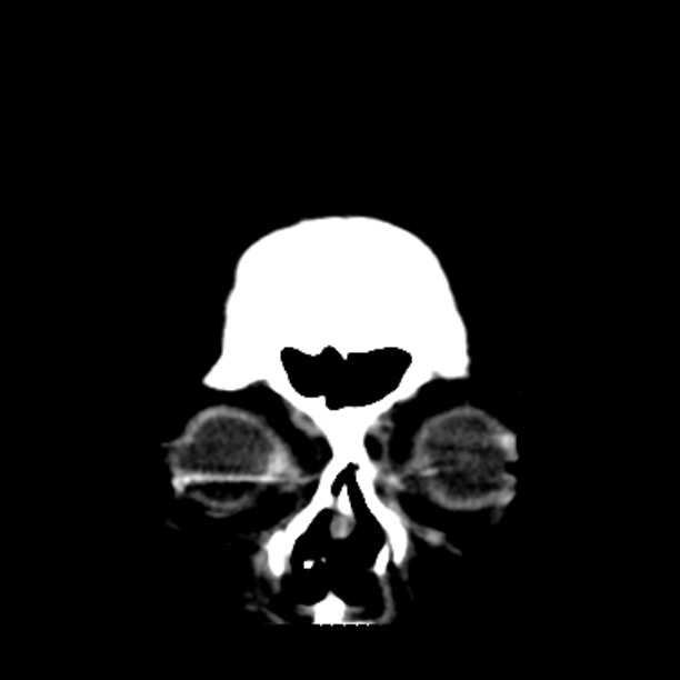 Brain cortical laminar necrosis (Radiopaedia 25822-25971 C 4).jpg