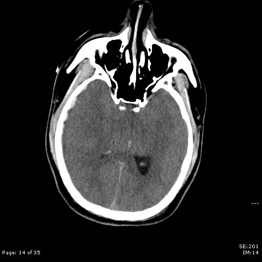 File:Brain death after motor vehicle collision (Radiopaedia 88470-105114 Axial non-contrast 14).jpg
