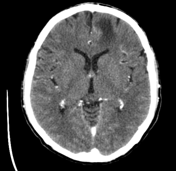 File:Brain metastases from lung cancer (Radiopaedia 24480-24781 Axial C+ delayed 29).jpg