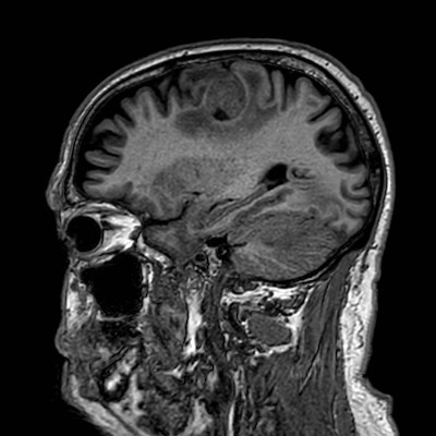 Brain metastases from lung cancer (Radiopaedia 83839-99028 Sagittal T1 89).jpg