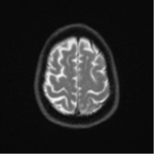 Brain metastasis (large cystic mass) (Radiopaedia 47497-52107 Axial DWI 23).png