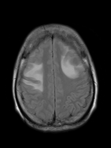 File:Brain metastasis as initial presentation of non-small cell lung cancer (Radiopaedia 65122-74126 Axial FLAIR 15).jpg