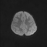 Brainstem glioma (Radiopaedia 67531-76922 Axial DWI 41).jpg