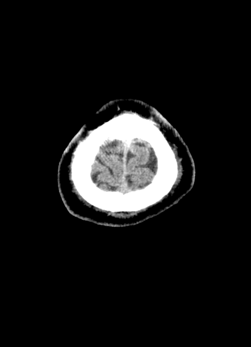 Brainstem hemorrhage (Radiopaedia 81294-94976 Axial non-contrast 6).jpg