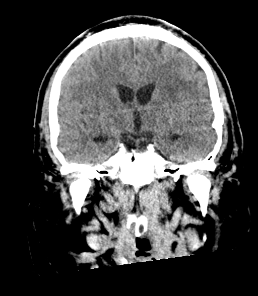 Brainstem hemorrhage (Radiopaedia 81294-94976 Coronal non-contrast 33).jpg