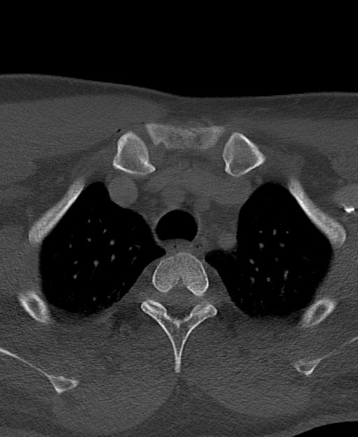 Branchial cleft cyst (Radiopaedia 31167-31875 Axial bone window 76).jpg