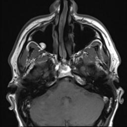 File:Branchial cleft cyst (Radiopaedia 31167-31876 Axial T1 29).jpg