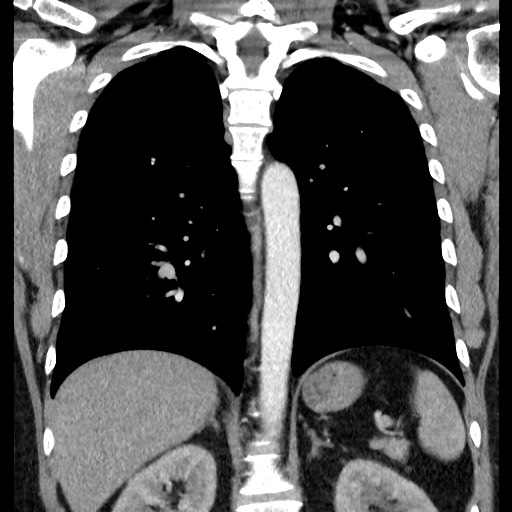 File:Bronchial carcinoid tumor (Radiopaedia 67377-76764 C 44).jpg