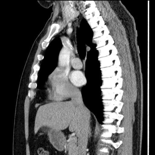 Bronchial carcinoid tumor (Radiopaedia 67377-76764 E 32).jpg