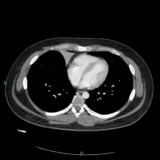Bronchial carcinoid tumor (Radiopaedia 78272-90875 A 63).jpg