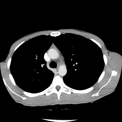 Bronchial carcinoid tumor causing right lower lobe collapse (Radiopaedia 83495-98594 A 16).jpg