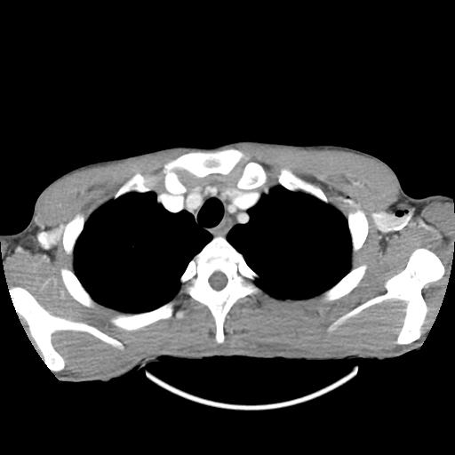Bronchial carcinoid tumor causing right lower lobe collapse (Radiopaedia 83495-98594 A 5).jpg
