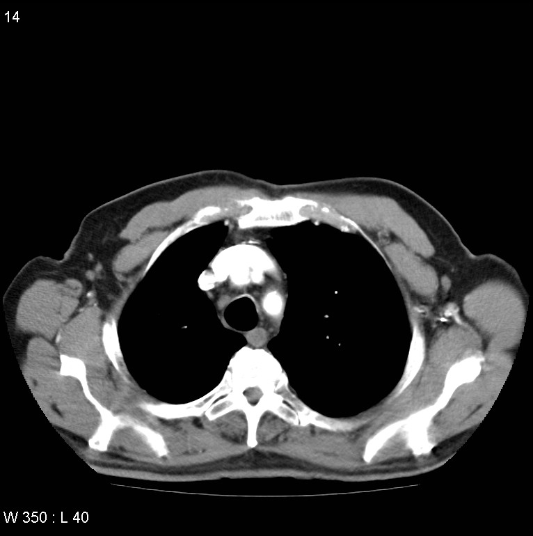 Bronchial carcinoid tumor with right lower lobe collapse (Radiopaedia 29060-29422 A 13).jpg