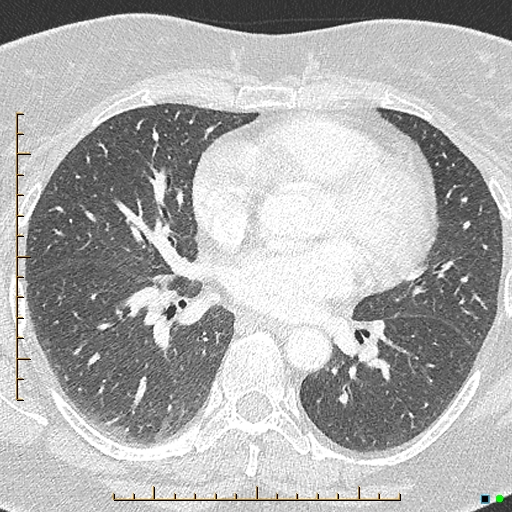 Bronchial diverticula (Radiopaedia 79512-92676 Axial lung window 109).jpg