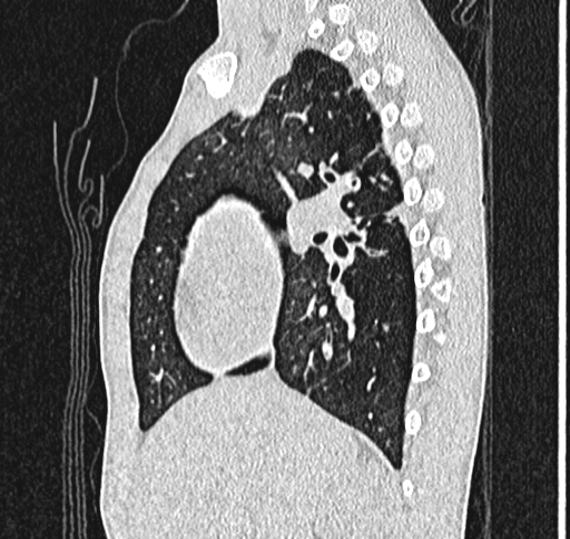 Bronchiolitis obliterans (Radiopaedia 71538-81897 Sagittal lung window 24).jpg