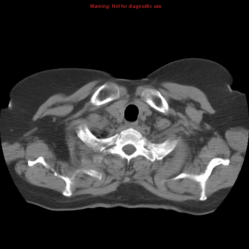 Bronchoalveolar carcinoma (Radiopaedia 13224-13233 Axial non-contrast 5).jpg