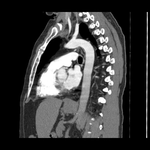 File:Bronchogenic carcinoma (Radiopaedia 47026-51562 Sagittal C+ CTPA 17).jpg