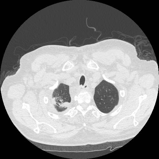 Bronchogenic carcinoma with metastatic lymphadenopathy (Radiopaedia 37671-39569 Axial lung window 8).jpg