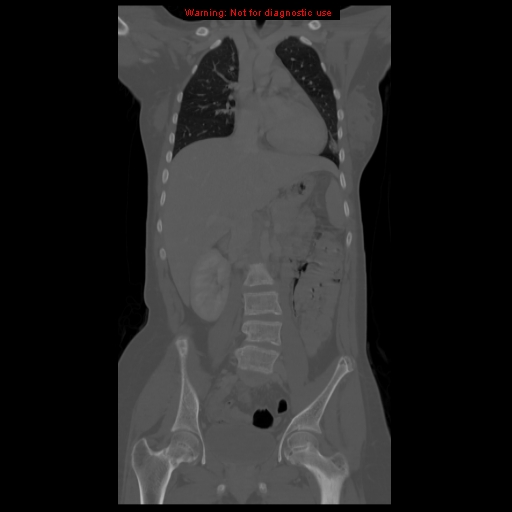 File:Brown tumor (Radiopaedia 12318-12596 D 33).jpg