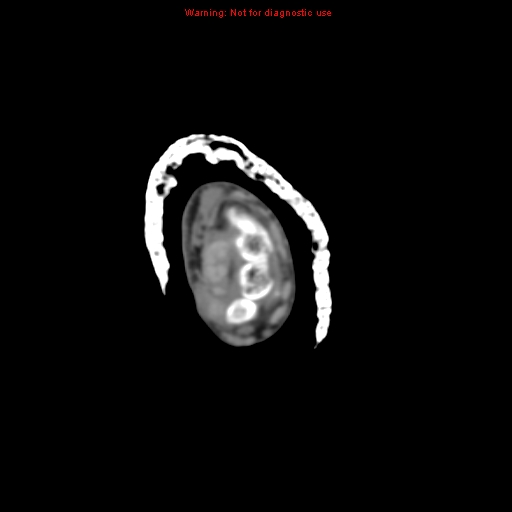 Brown tumor (Radiopaedia 12460-12694 Axial non-contrast 8).jpg