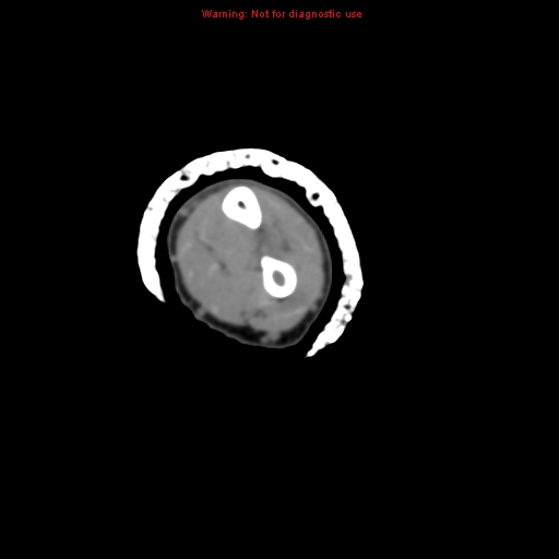 File:Brown tumor (Radiopaedia 12460-12694 Axial non-contrast 89).jpg
