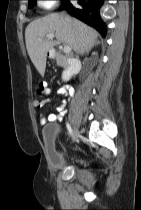 Brown tumors compressing the spinal cord (Radiopaedia 68442-77988 F 23).jpg