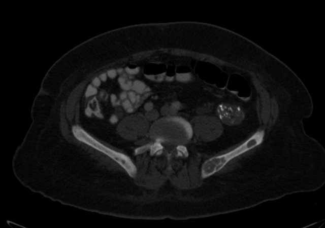 Brown tumors compressing the spinal cord (Radiopaedia 68442-77988 G 83).jpg