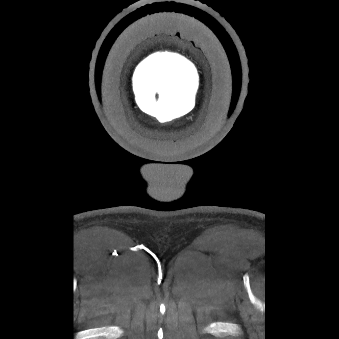 Buccal fat pad arteriovenous malformation (Radiopaedia 70936-81144 B 60).jpg