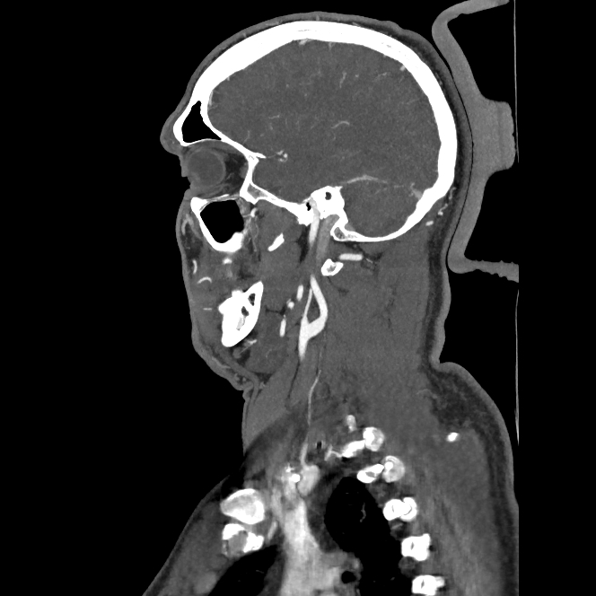 Buccal fat pad arteriovenous malformation (Radiopaedia 70936-81144 C 57).jpg