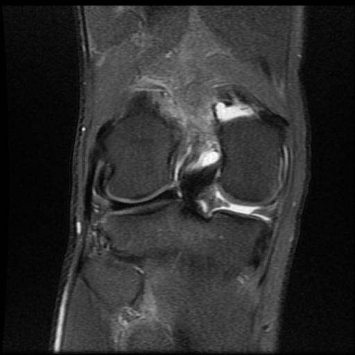 File:Bucket handle tear - medial meniscus (Radiopaedia 69245-79026 Coronal PD fat sat 14).jpg