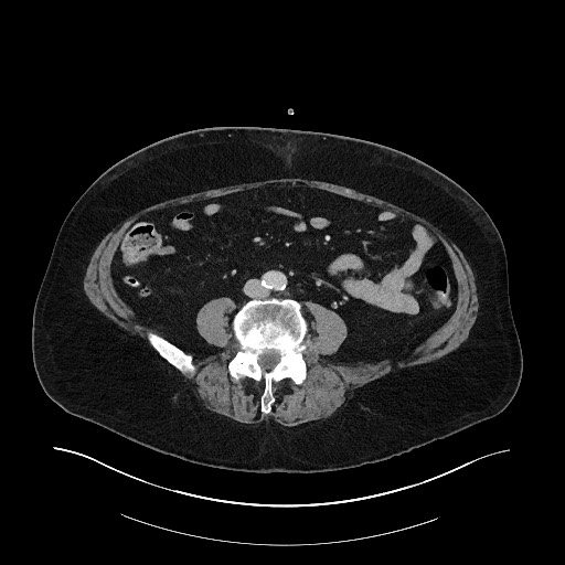Buried bumper syndrome - gastrostomy tube (Radiopaedia 63843-72575 A 60).jpg