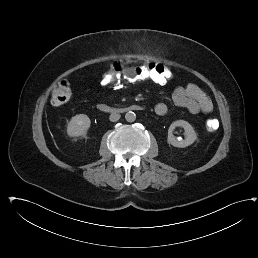 Buried bumper syndrome - gastrostomy tube (Radiopaedia 63843-72577 Axial Inject 52).jpg