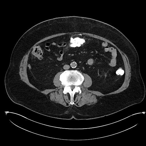 Buried bumper syndrome - gastrostomy tube (Radiopaedia 63843-72577 Axial Inject 62).jpg