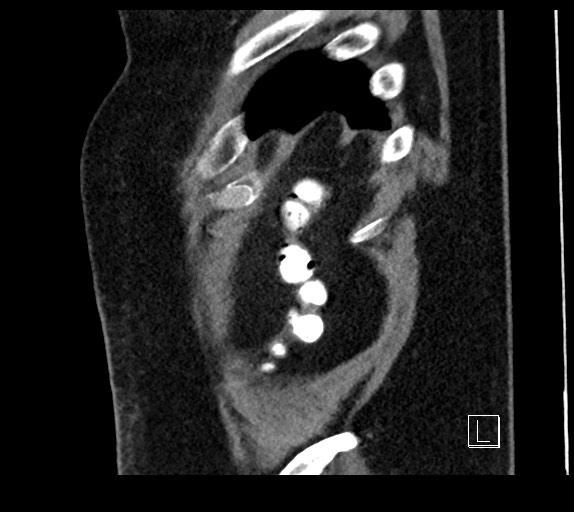 Buried bumper syndrome - gastrostomy tube (Radiopaedia 63843-72577 Sagittal Inject 9).jpg