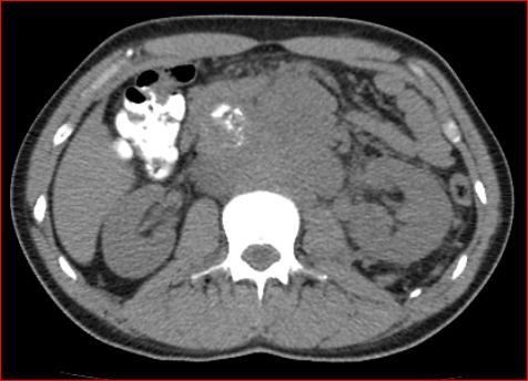 File:Burned-out testicular choriocarcinoma (Radiopaedia 32822-34040 Axial non-contrast 9).jpg