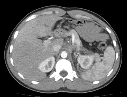 File:Burned-out testicular choriocarcinoma (Radiopaedia 32822-34040 B 2).PNG