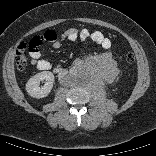 Burned-out testicular seminoma - retroperitoneal nodal metastases (Radiopaedia 62872-71245 A 38).jpg