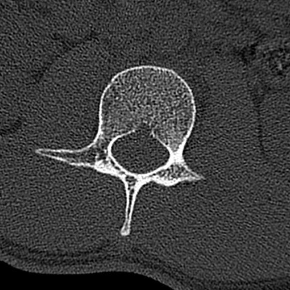 Burst fracture (Radiopaedia 53373-59357 Axial bone window 23).jpg