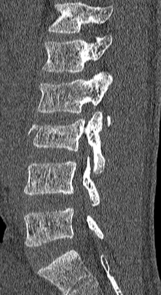 Burst fracture (Radiopaedia 53373-59357 Sagittal bone window 50).jpg