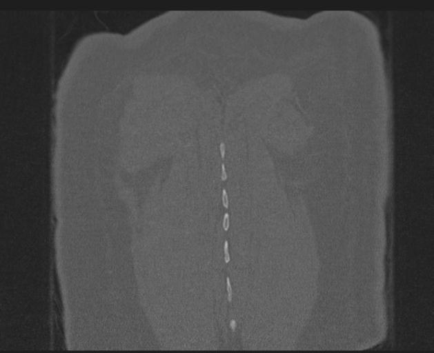 Burst fracture - thoracic spine (Radiopaedia 30238-30865 Coronal bone window 151).jpg